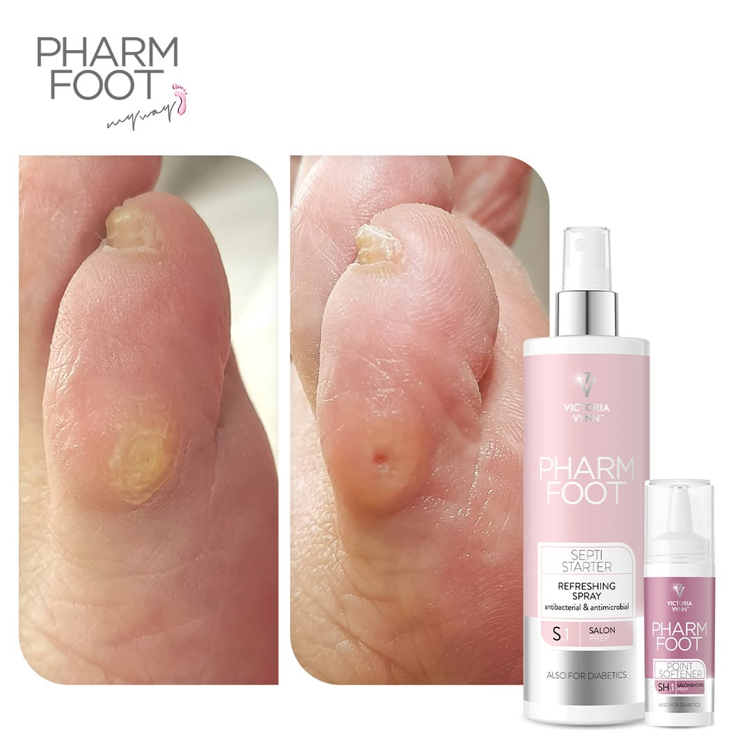 PHARM FOOT Corn Removal Kit